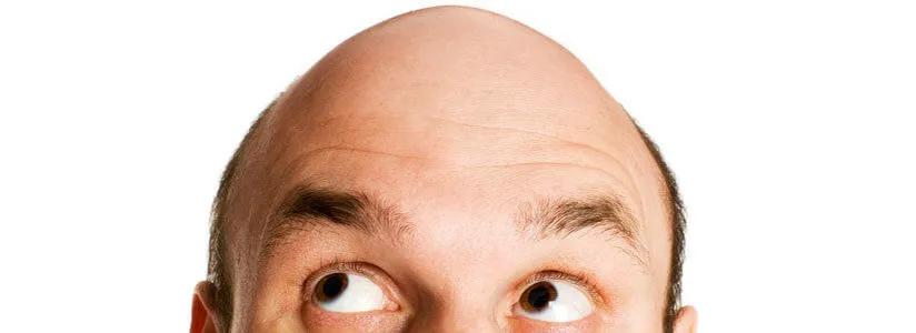 米诺地尔脱发女士专用,米诺地尔对于m型脱发非常有效果