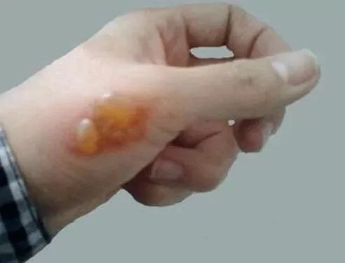 艾灸胃食管反流艾灸哪个穴位,艾灸配穴是几个穴位同时艾灸吗