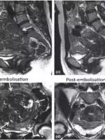 子宫肌瘤腺肌症微创介入科普动画,子宫肌瘤适合微创手术吗