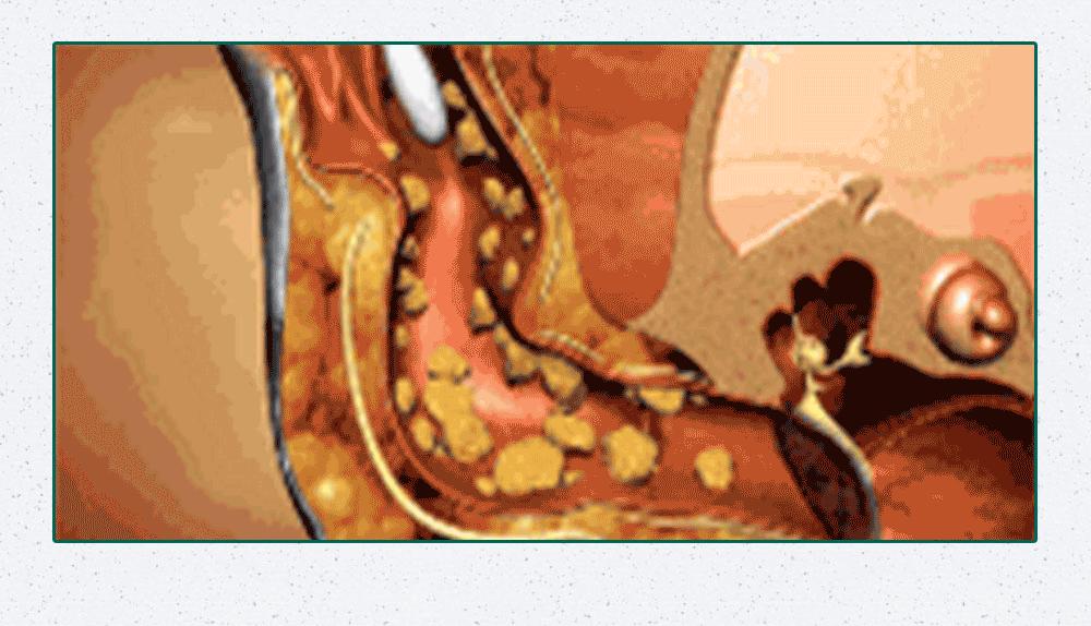 看看8年没有掏耳屎是什么样子,十年不掏耳屎你耳朵有多脏