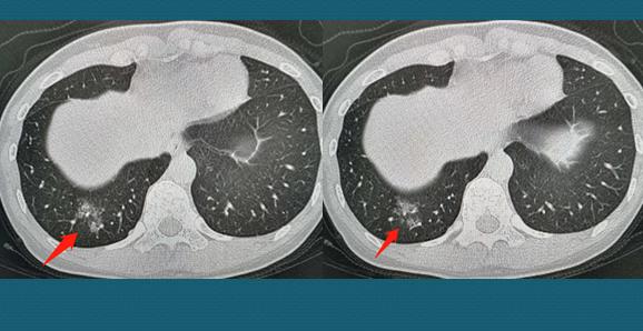 两名病情好转的心冠患者,轻度病毒性肺炎20天快好了