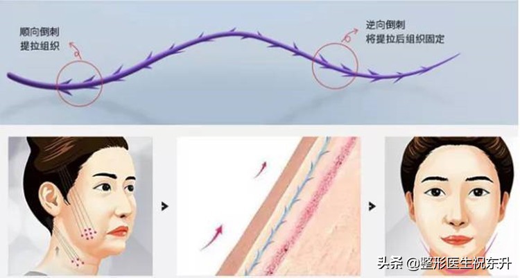面部线雕副作用图片,做线雕脸部提升有什么副作用