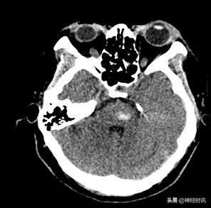一例脑干出血的个案护理,外伤性脑干出血保守治疗成功案例