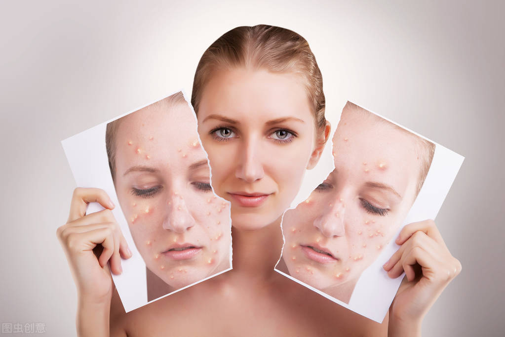 我又长痘了怎么回复,原本脸上没有痘突然脸上爆痘