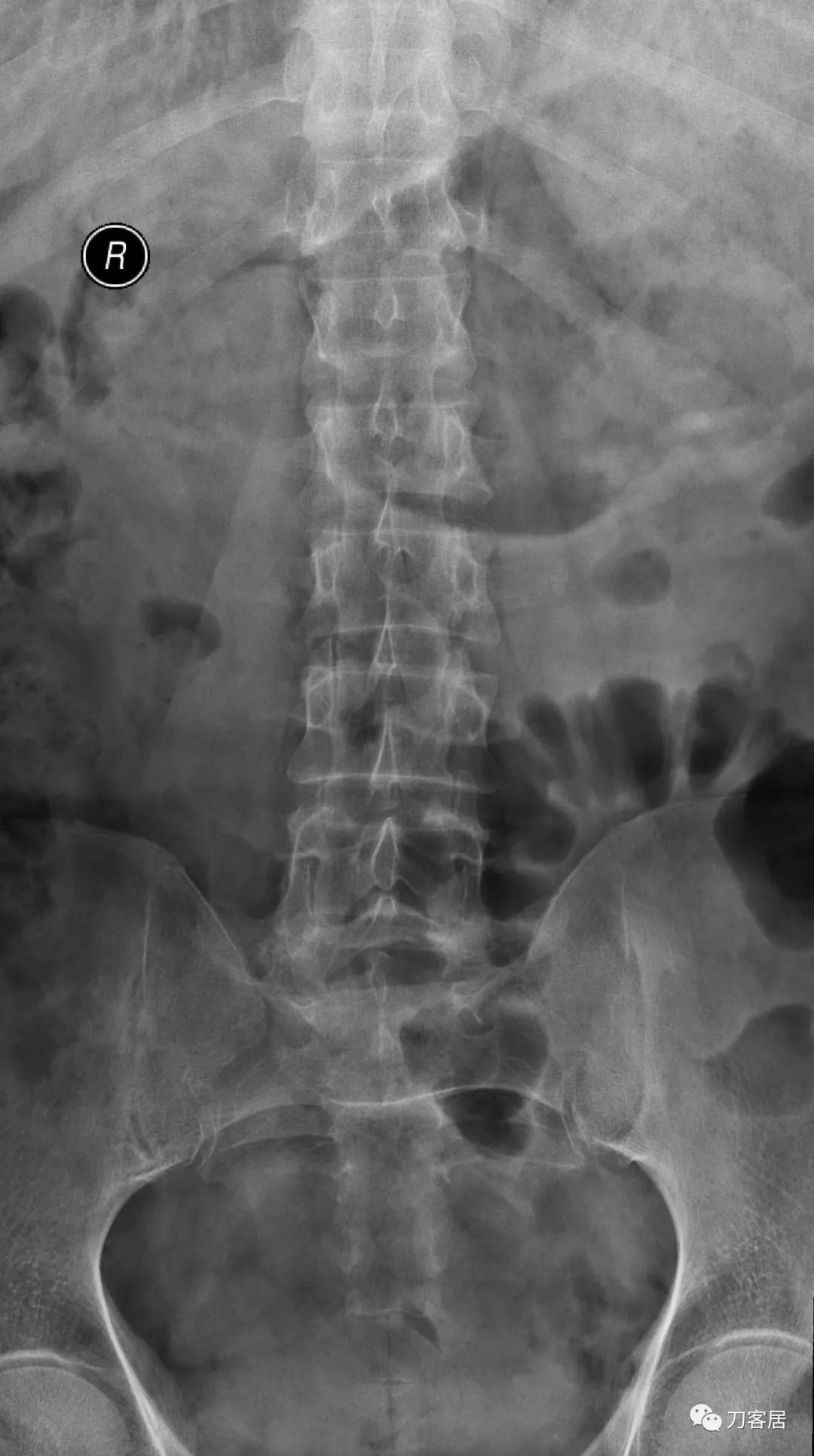 小针刀扎到坐骨神经会瘫痪吗,小针刀会切断坐骨神经吗