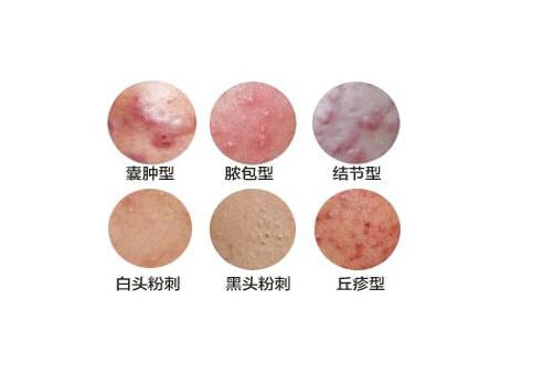 皮肤科医生讲的故事,皮肤科看痘痘痘印