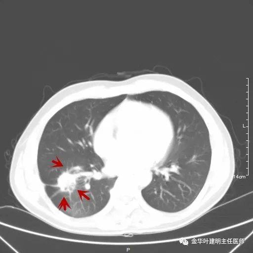 伴有脑转移了的肺癌能手术吗？