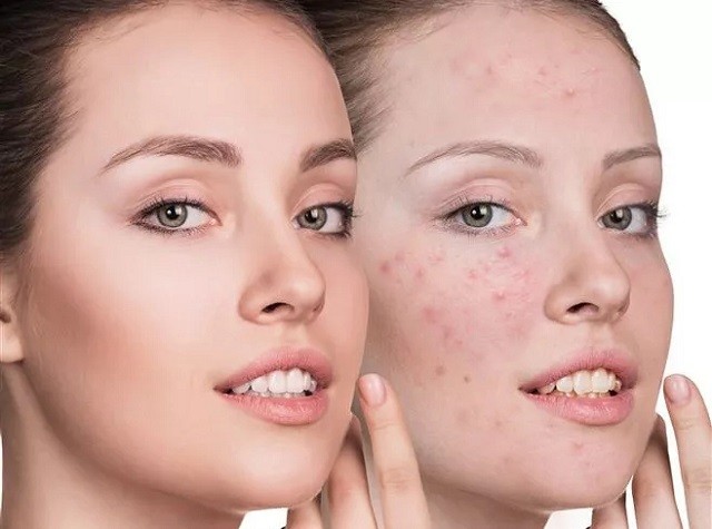 敏感肌肤长痘痘怎么改善，敏感肌爱用的护肤品牌良心推荐