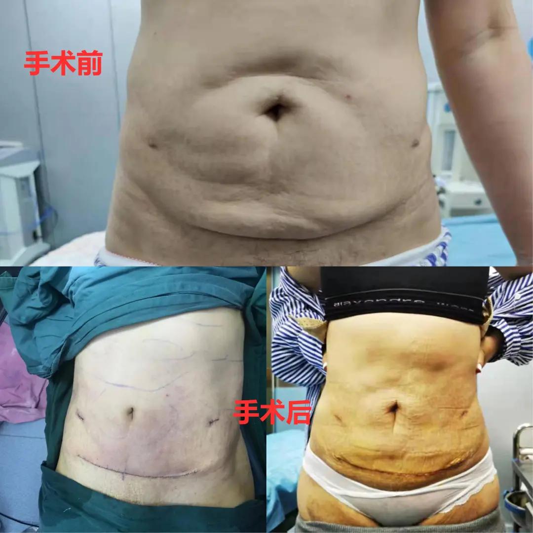 腹壁整形和剖腹产哪个创伤大,腹壁整形和腹直肌一起做吗