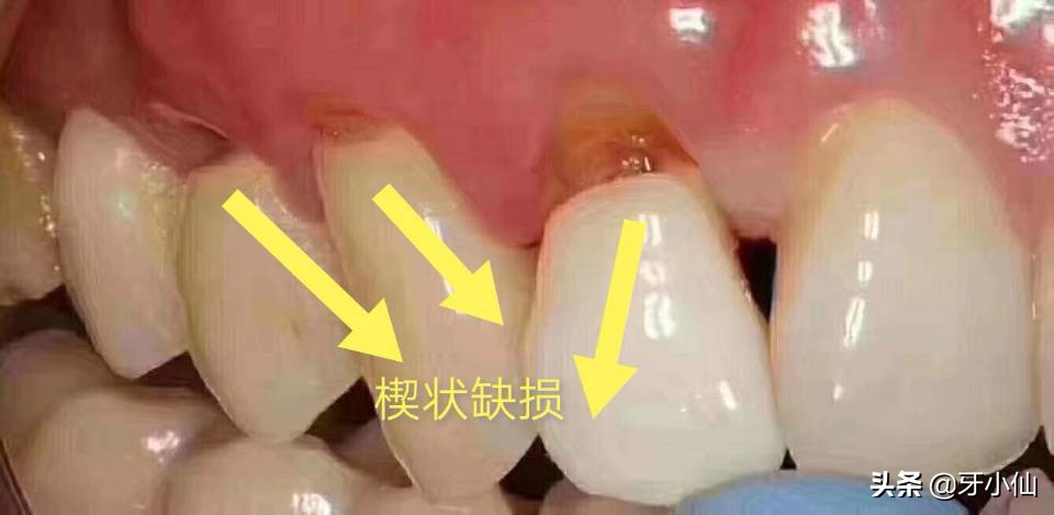 牙太痛,吃不了热辣火锅、冰爽雪糕、酸甜水果,怎么能当吃货?