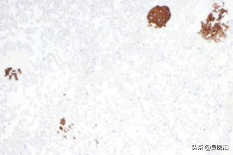 NEJM病例：36岁孕妇，诊断腺癌
