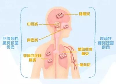 肺炎链球菌怎样治疗才能痊愈,肺炎链球菌的治疗原则是什么