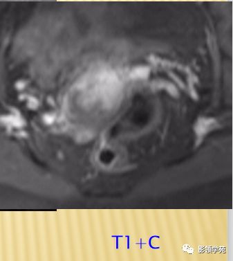宫颈癌mri诊断,宫颈癌的mr扫描技术
