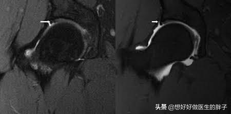 髋关节疼痛会引起腿痛吗,髋关节疼痛两腿不一样长如何康复