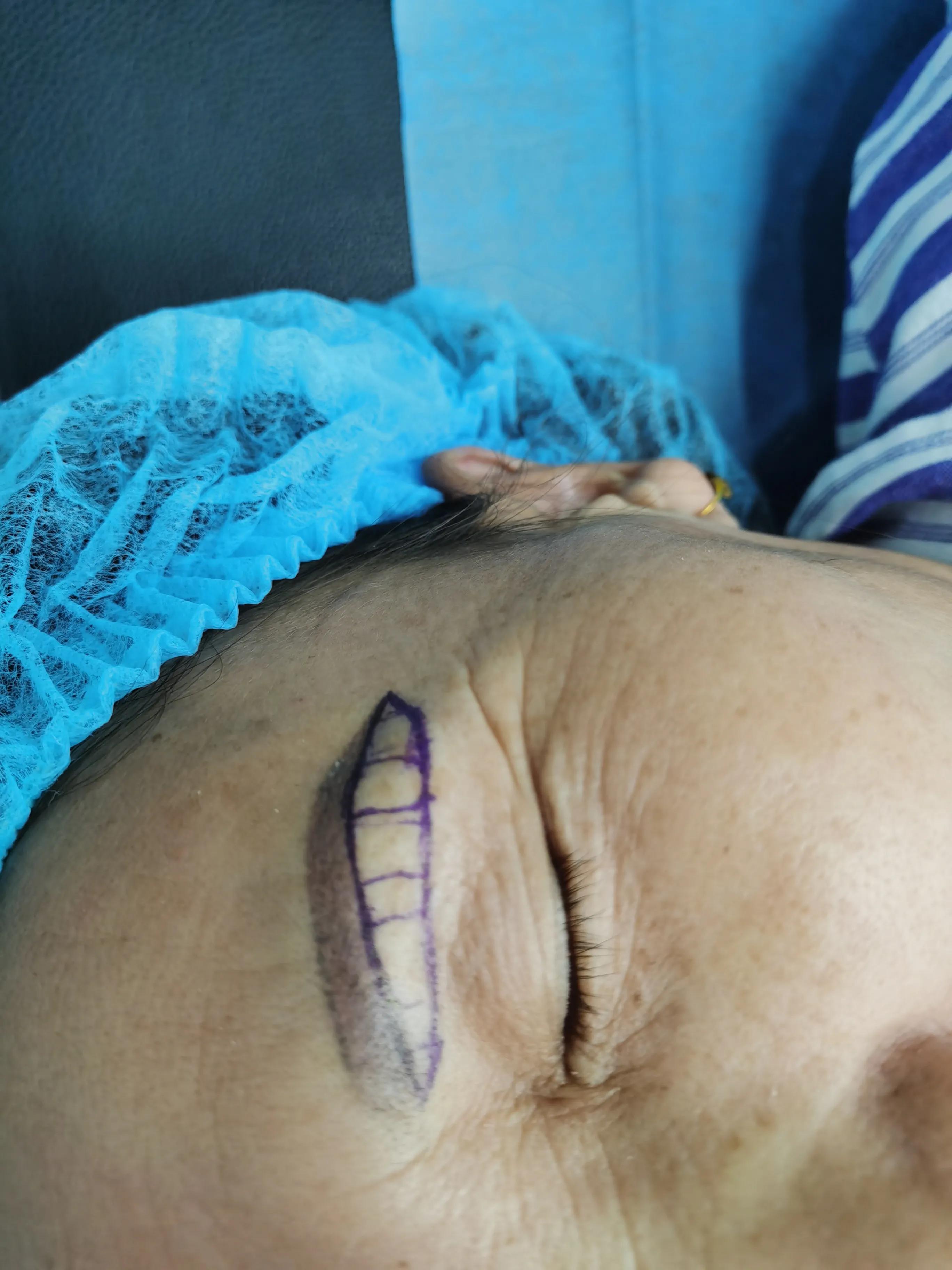 整形手术除皱会反弹吗,整形手术会不会有后遗症