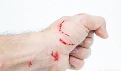 没有被猫狗咬可以打狂犬病疫苗吗,被家猫咬伤出血要打狂犬疫苗吗