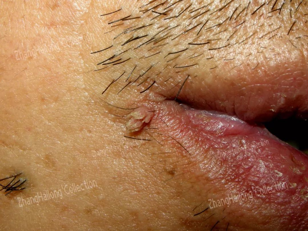 为什么会长瘊子,脚底为什么会长瘊子