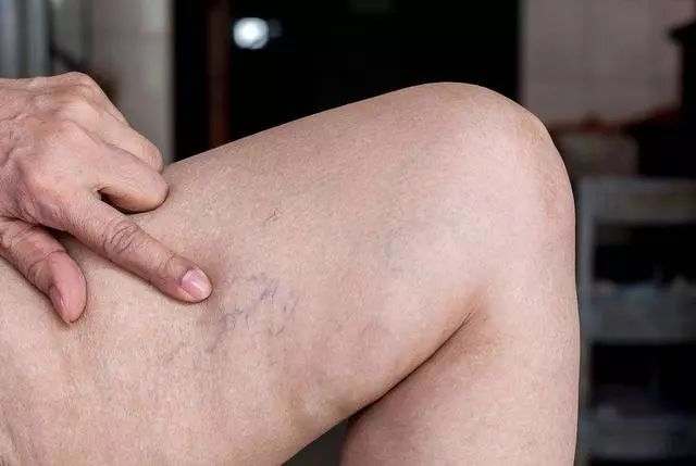 血液粘稠时身体会发出4个信号,血液粘稠有什么症状会睡眠不好