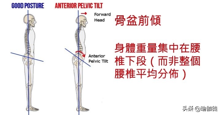 翘屁股影响发育吗,翘二郎腿骨盆倾斜危害