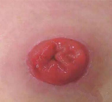 肠造口手术后出院回家的自我观察和自我护理