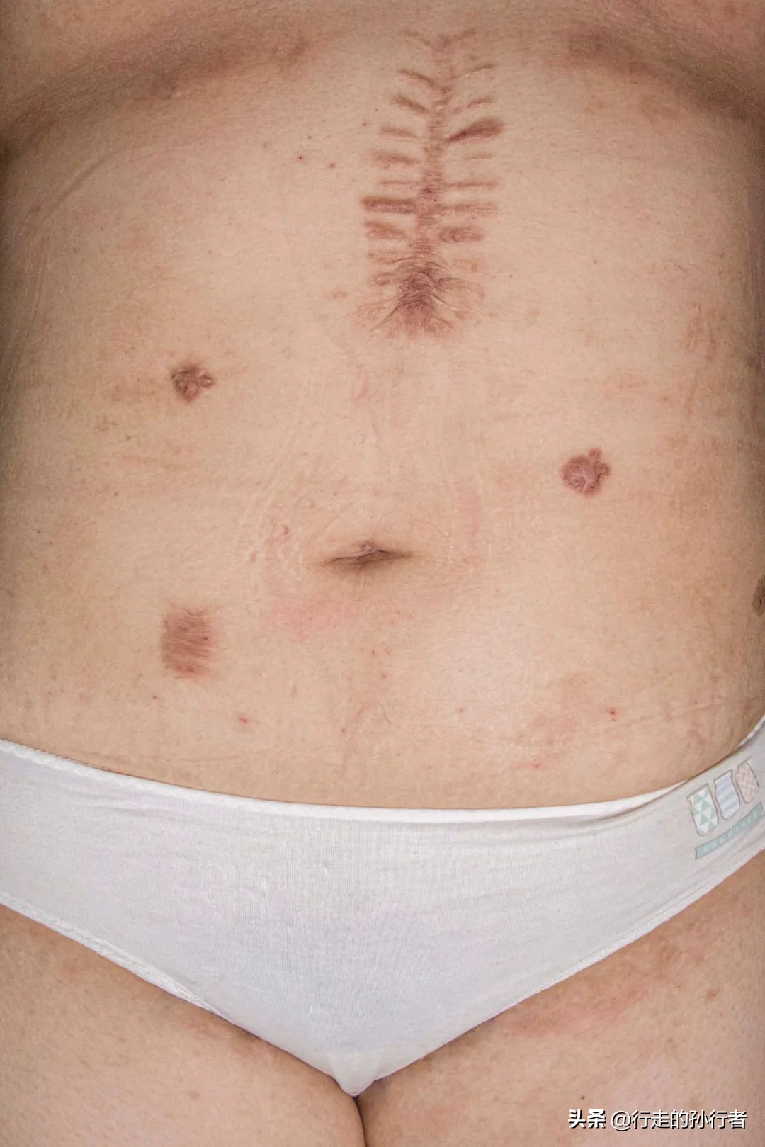 切胃减肥手术的副作用,为了减肥切胃到底值不值