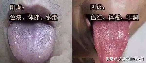 艾灸没效果甚至越灸越虚？先看看阳虚，阴虚怎么分辨