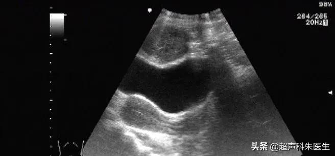 未婚女性卵巢查出包块,女左下腹有肿块是癌症吗