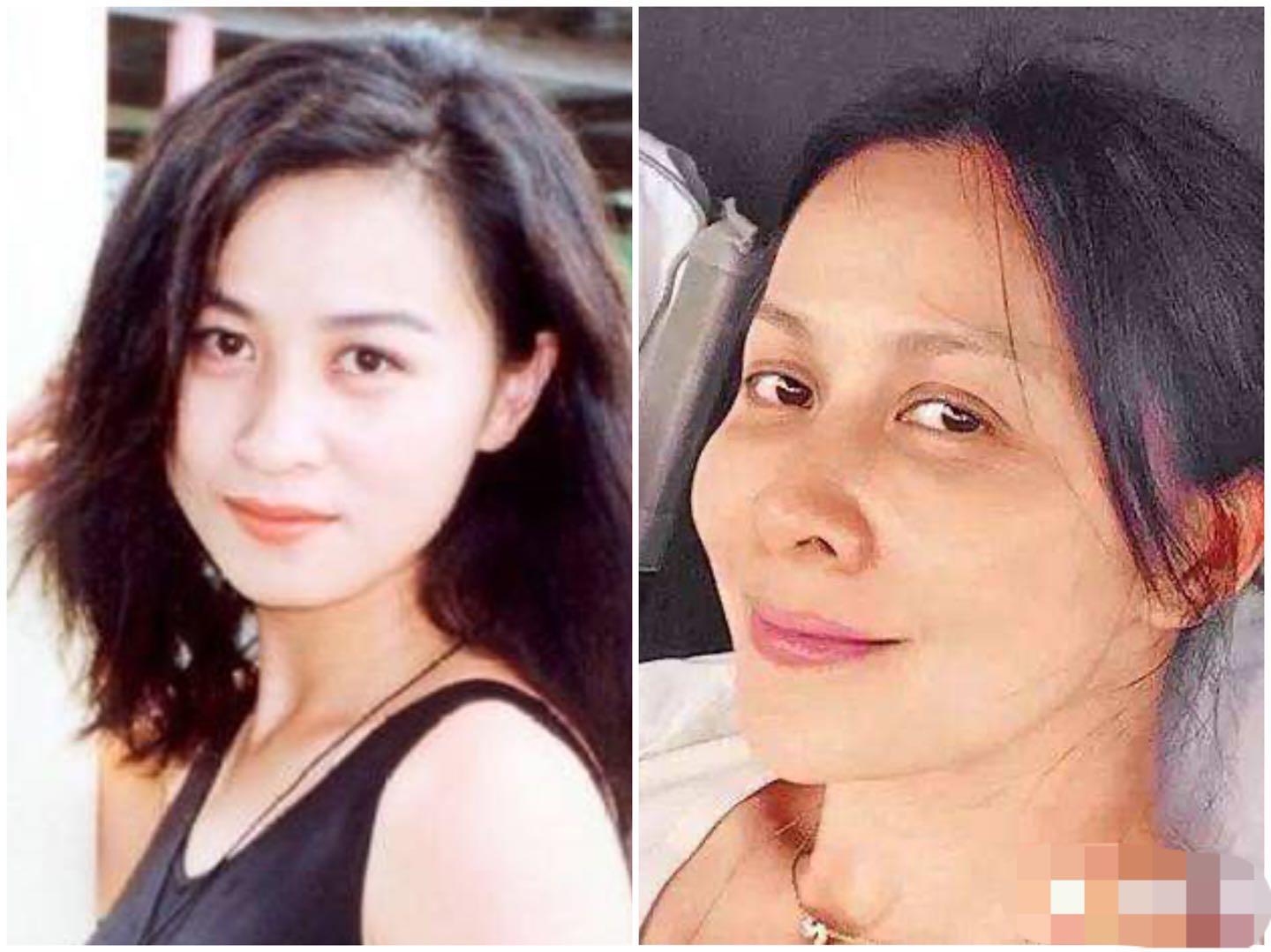 打水光针和打除皱针哪种好,打水光针和除皱针哪个好