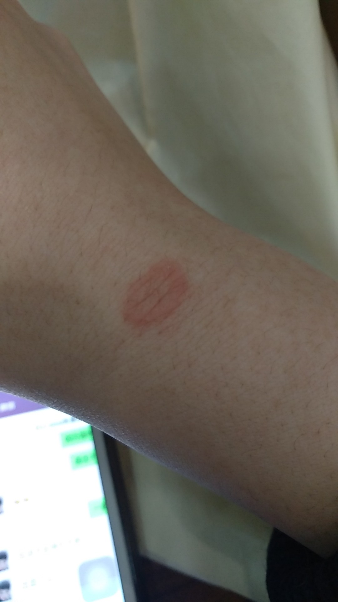 猫咪得了猫癣怎么才能治好它,小猫咪得了猫癣用碘伏可以治愈吗