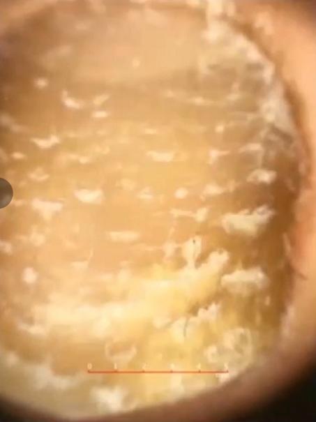 治灰指甲要验血吗,医院检查灰指甲挂号什么科