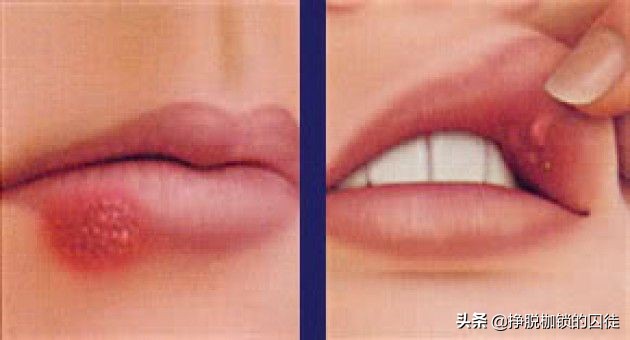 西医的炎症和中医的上火有啥区别,上火跟炎症的区别