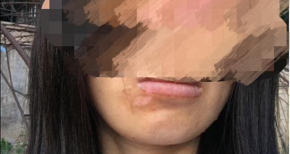 拔完智齿第三天就开始撸串了,智齿拔完一周可以撸铁吗