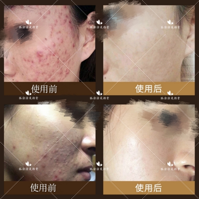 什么产品祛痘痘痘印效果好呢,祛痘印最好用的产品