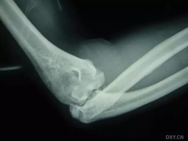 所有骨折都叫什么名字,骨折的名称有哪些