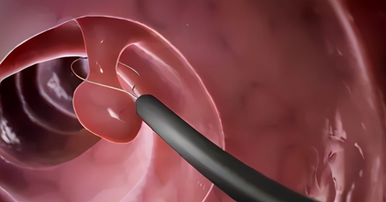 肠息肉0.5厘米是观察好还是切除好,查出肠息肉是不是必须切除