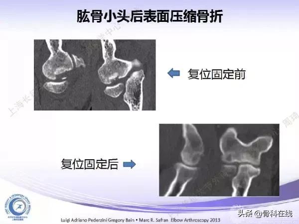 肘关节镜手术后引流,肘关节镜微创手术