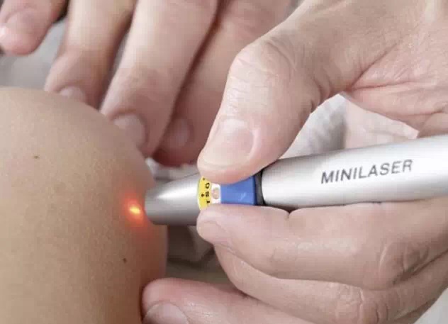 针灸的激光有什么用,医用激光针灸