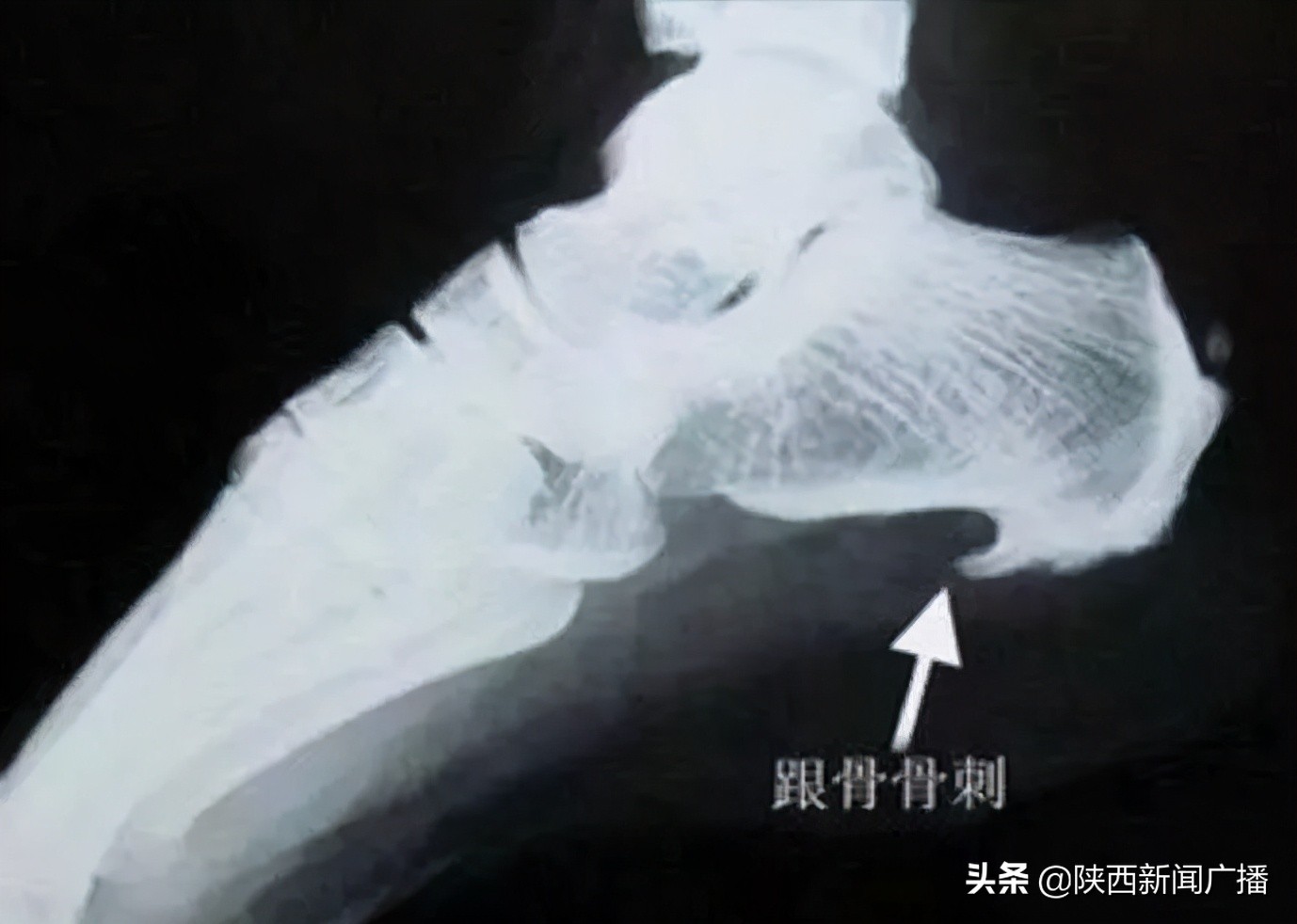 脚后跟疼是怎么回事中医,脚后跟疼是怎么回事一走路就疼