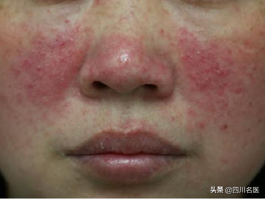 一把年纪了脸上还爆痘,一把年纪了脸上还起痘