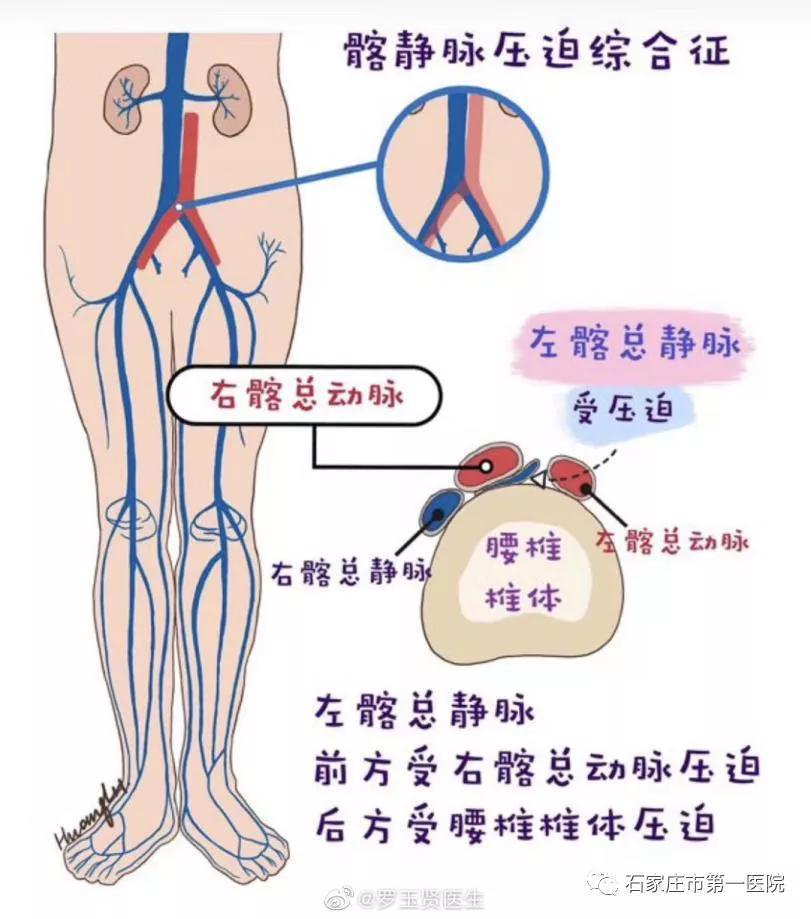 脚腕上有青筋是静脉曲张吗,青筋暴露是指血管吗