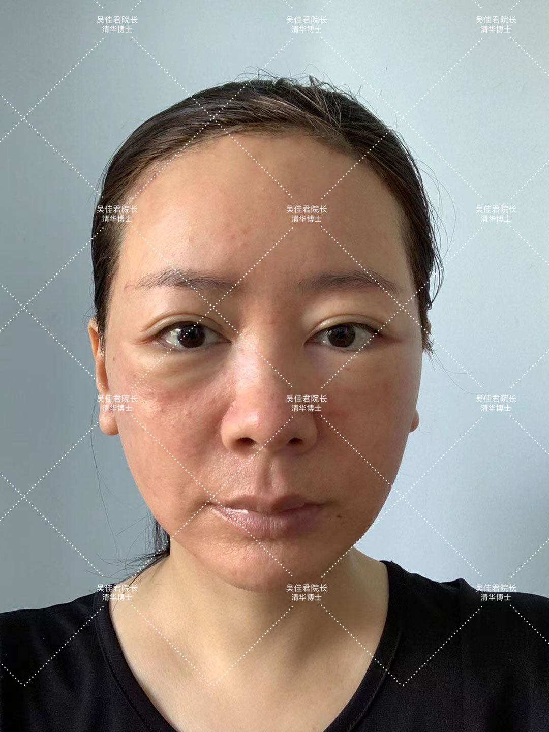 拉皮手术会加速衰老吗亲身经历,40多岁做小拉皮术后6个月