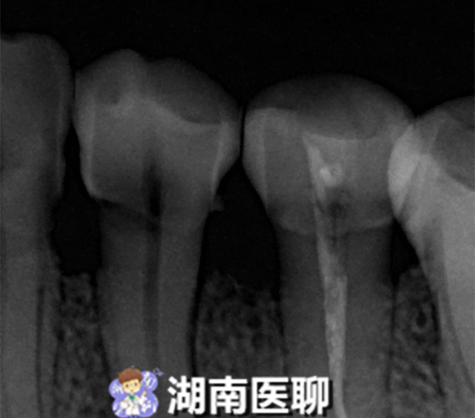 牙齿有洞很痛可以用牙痛药水吗,牙齿疼痛怎么办土方法治牙疼