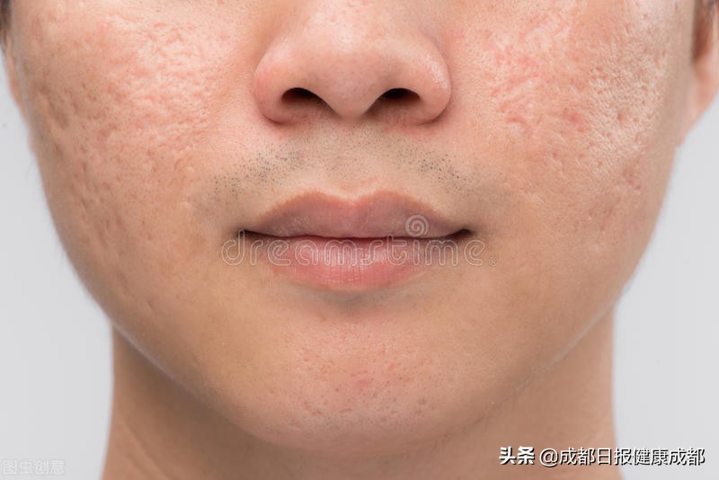 如何抚平烧伤疤痕,怎么去除厚厚的烧伤疤痕增生