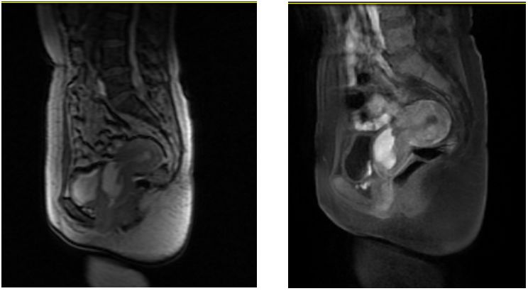 子宫疤痕憩室的思考,无症状子宫瘢痕憩室