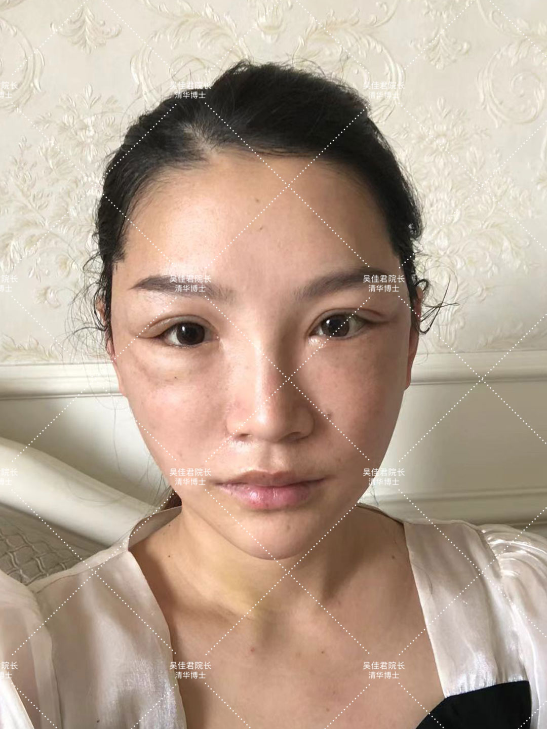 31岁做小拉皮,40岁做小拉皮的视频