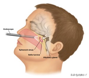 小丫说医｜一类影响全身的特殊脑瘤——“蝶鞍邂逅瘤”