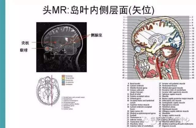 mra头颅解剖学详细讲解视频,常见的头颅mri图像