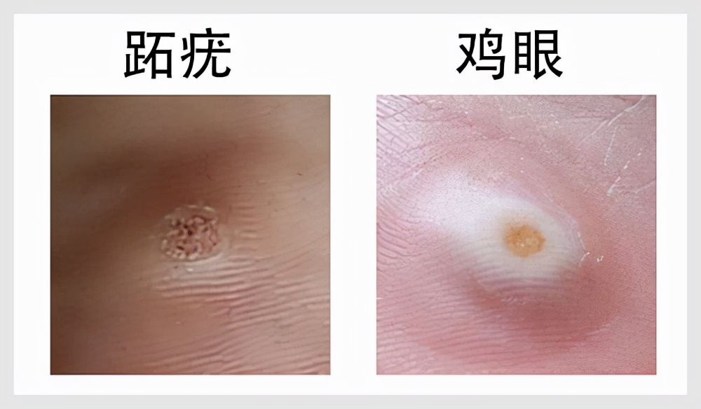 脚上长了跖疣能自愈吗,跖疣冷冻后变刺瘊