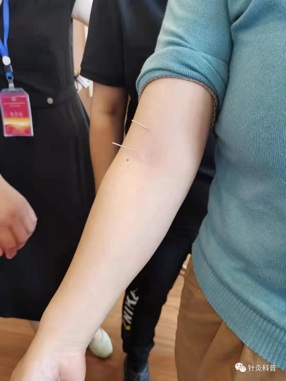 针灸治疗常见疾病方法,伤寒杂病论和针灸