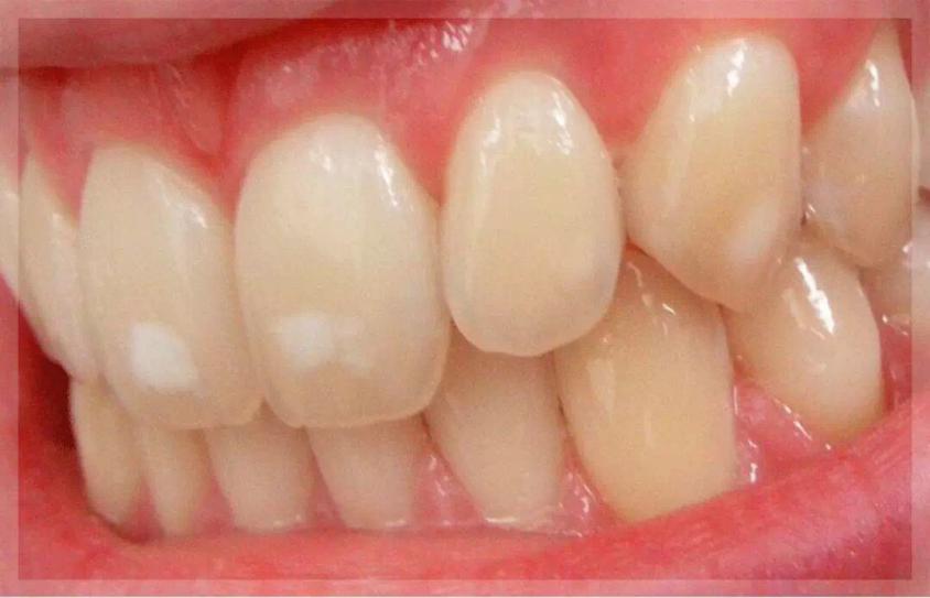 牙齿刷完白了过一会又黄了,牙齿涂氟涂一次大概多长时间